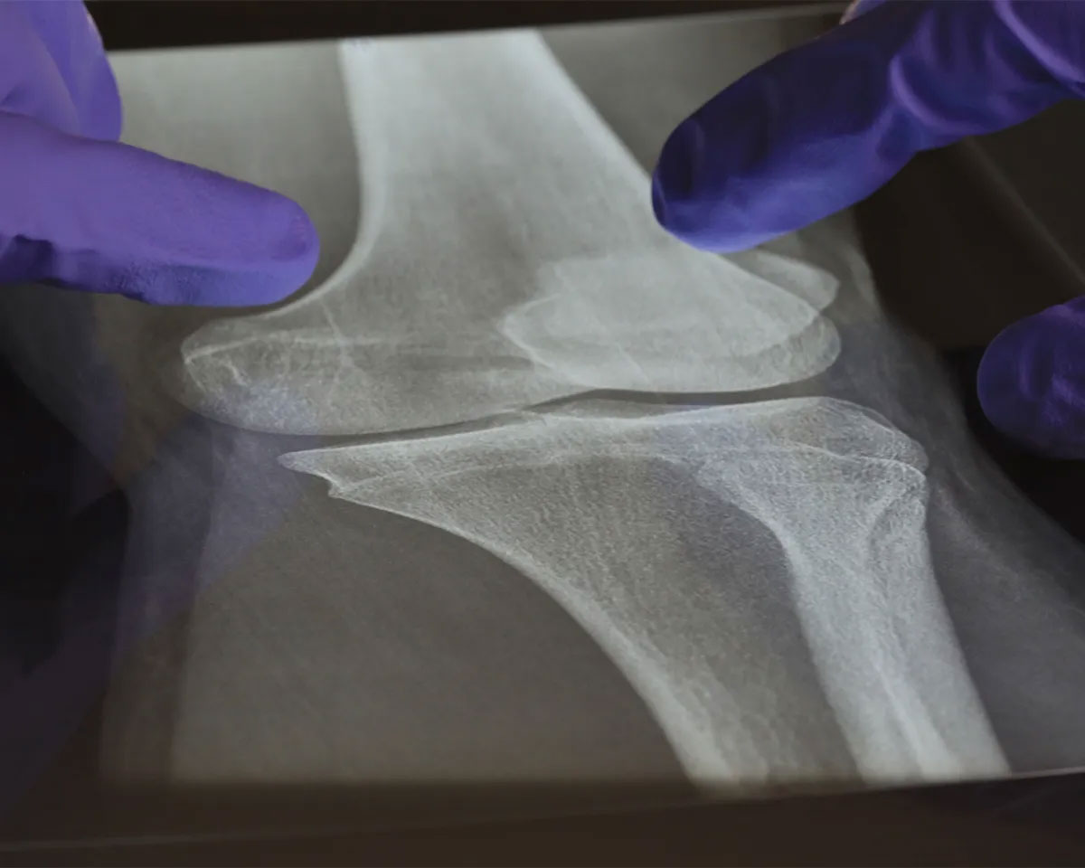 X-ray of bones