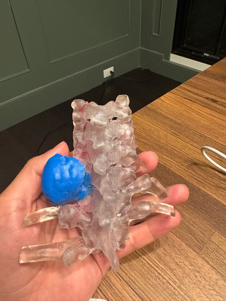 Hayden's 3D model of her spine and tumor