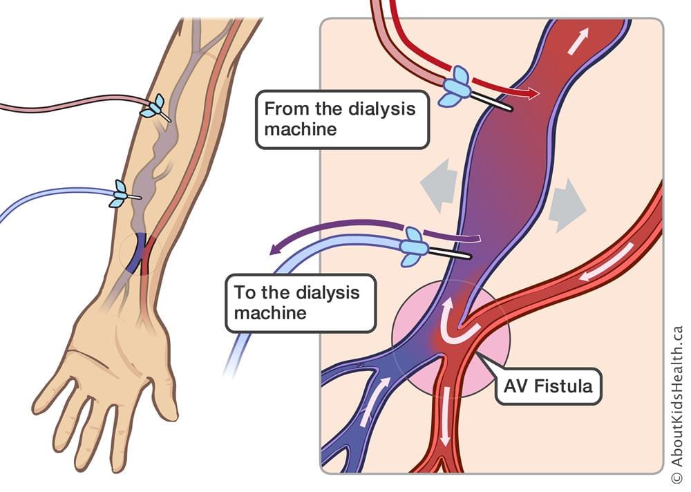 Diagram demonstrating dialysis machine to AV Fistula