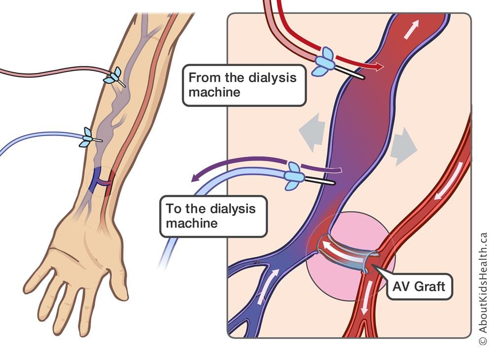 Diagram demonstrating dialysis machine to AV graft