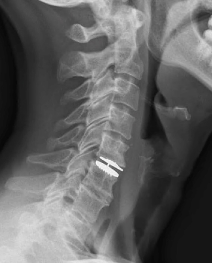 disk replacement x-ray